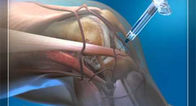 Injection orthopédique de produits et injection de genou d'acide hyaluronique d'instrument de piqûre